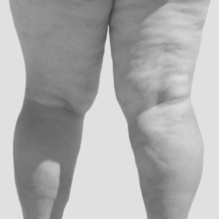 Lipedema Treatment in Cyprus Expert Procedures for Lasting Results